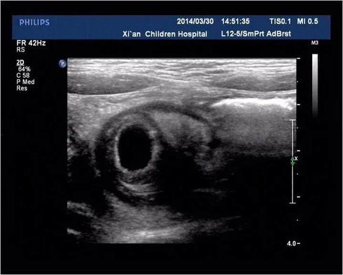 成人肠梗阻超声表现视频,成人肠梗阻超声诊断要点解析