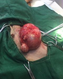 成人疝气手术伤口视频,成人疝气手术伤口全程解析