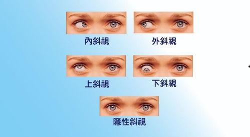 成人斜视的悲哀视频讲解