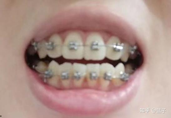 成人补牙齿视频过程图解